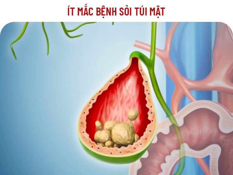 Ít Mắc Bệnh Sỏi Túi Mật