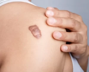 Ăn nước mắm có để lại sẹo? Giải mã lời đồn dai dẳng